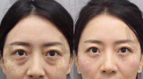 深圳鹏程医院治疗疤痕的价格与预约