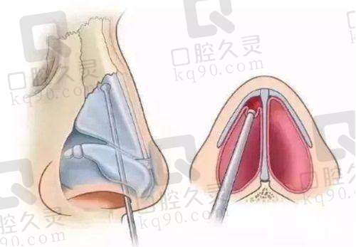 深圳鹏程鼻综合整形的价格贵吗？
