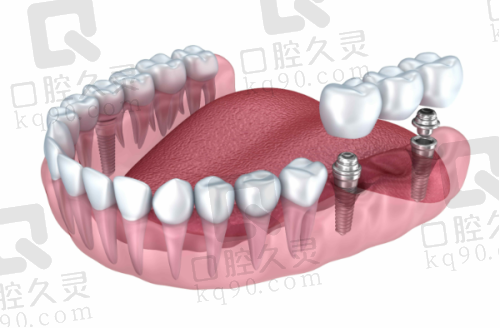 苏州牙博士口腔医院牙齿矫正价格：适合不同年龄段的定制化整牙方案