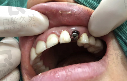 武汉大众口腔医院综合治疗一览：补牙拔牙都不贵，看牙也能随心所欲