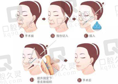 三、 XX地区XX项目收费情况