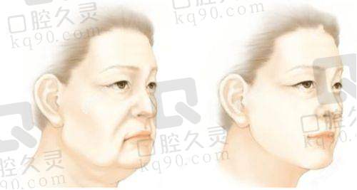 杭州艺星鼻部整形收费价格分析