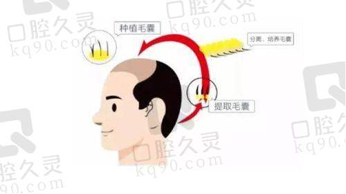 太原碧莲盛医疗美容诊所（植发专科）技术好不好？