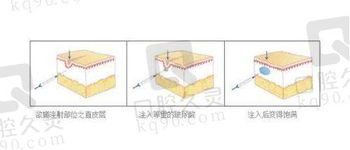 成都美茵医疗美容的特色项目——半岛黄金超声炮
