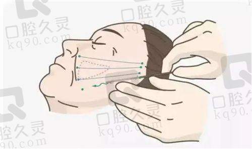 成都中医大银海修复馒化脸怎么样？可视化检测与三步法还原面部自然紧致平整效果 
