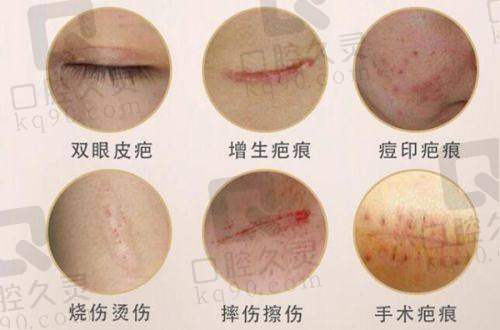 秦皇岛巧致整形医院靠谱吗？有超声炮授权，项目价优，张凯华割双眼皮效果佳