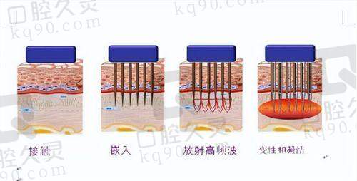 二、北京黄寺罗焕琴伊诺锶黄金微针面部项目的价格情况