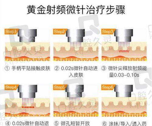 北京黄寺罗焕琴伊诺锶黄金微针面部2390元起，精准改善眼周细纹焕新肌肤