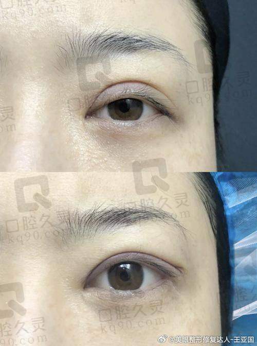 如何选择适合自己的双眼皮手术？