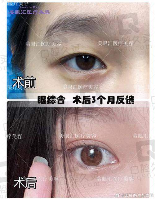 五、总结王春霞医生双眼皮技术