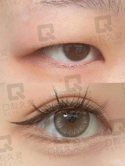 武汉美莱张倩倩做眼综合仅需8800元起，术后效果自然，个性化方案备受好评