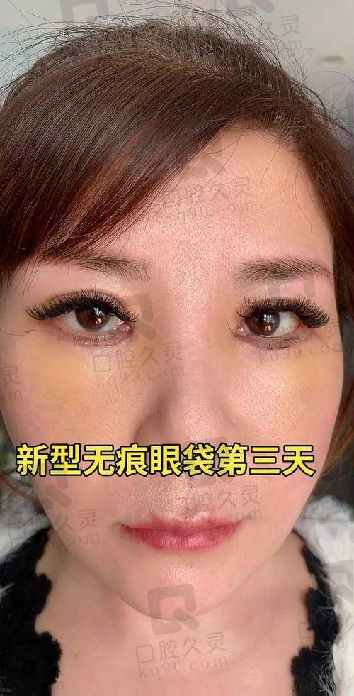 3. 激光去眼袋
