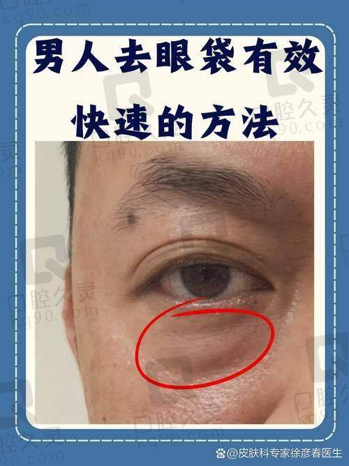 5. 综合眼袋修复手术