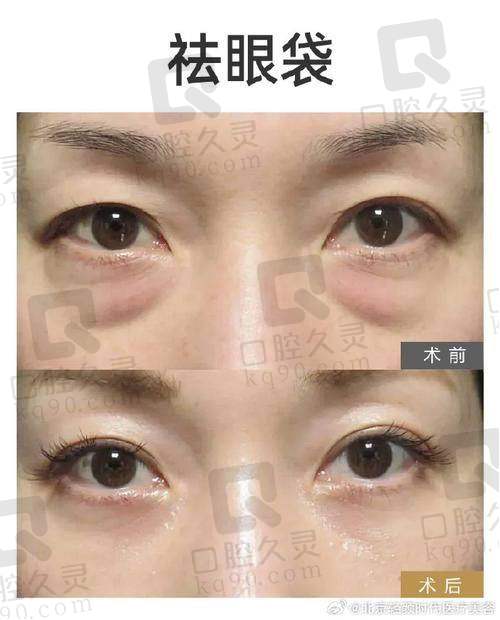 实例2：李明，28岁 - 吸脂去眼袋