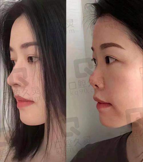 深圳鹏程鼻综合整形术后成效如何？