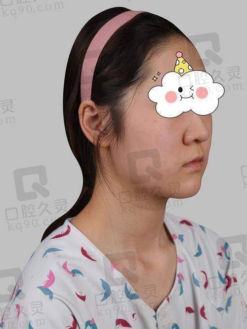 四、李冰医生隆鼻成效的真实评价
