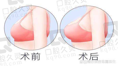 吕京陵医生隆胸手术预约全流程公开：电话、在线登记轻松预约丰胸手术