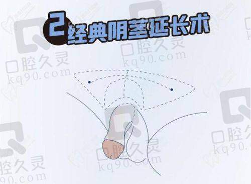 重庆松山男科吸脂延长阴茎术价格19800元起，美学导向个性化设计结合阴茎形态手术