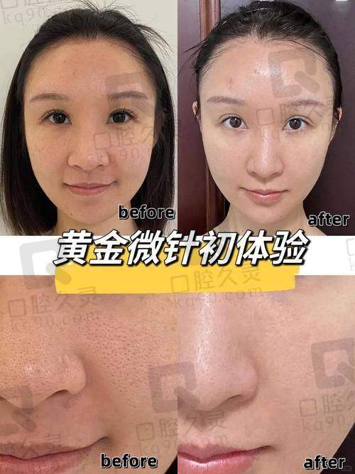 三、北京黄寺罗焕琴伊诺锶黄金微针面部项目的优势体现