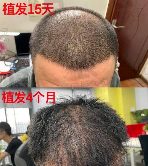 太原碧莲盛医疗美容诊所（植发专科）口碑如何？