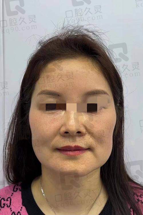贺焕焕做拉皮提升怎么样?贺焕焕医生做拉皮技术好、口碑棒,放心选