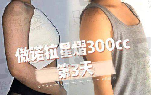 天津爱丽诺整形医院双眼皮手术价格