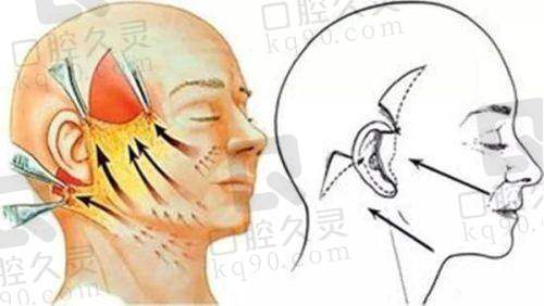 玻尿酸注射成效怎样？
