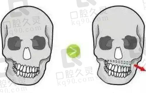 任义医生高难度鼻修复的价格构成