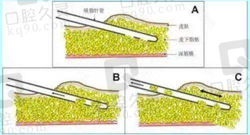 三、百色华美整形价格表详细解读