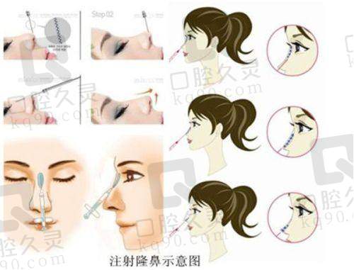 北京煤医周云超取异物技术优势解析
