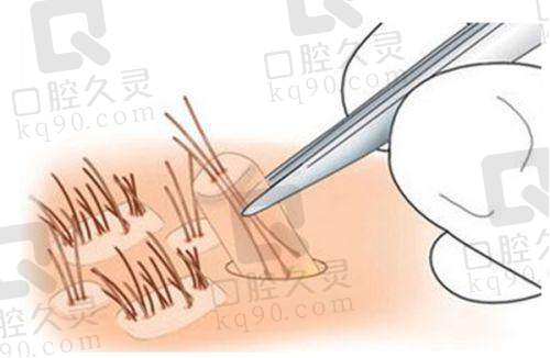植发项目科普之发际线种植