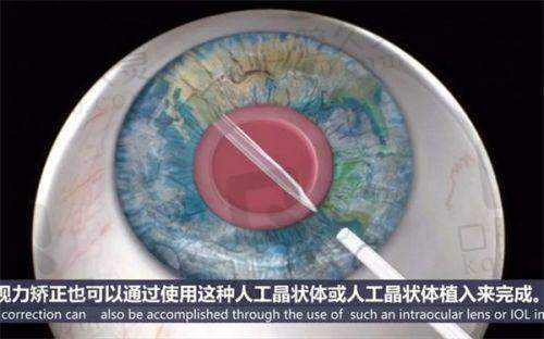 天水市一院眼科收费大揭秘！白内障8000、近视手术1.7万，省钱有招！