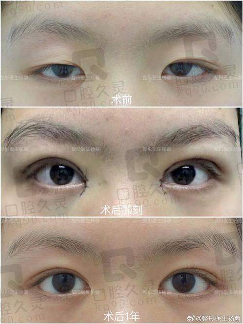 五、姚江华修复实例中的双眼皮修复优势