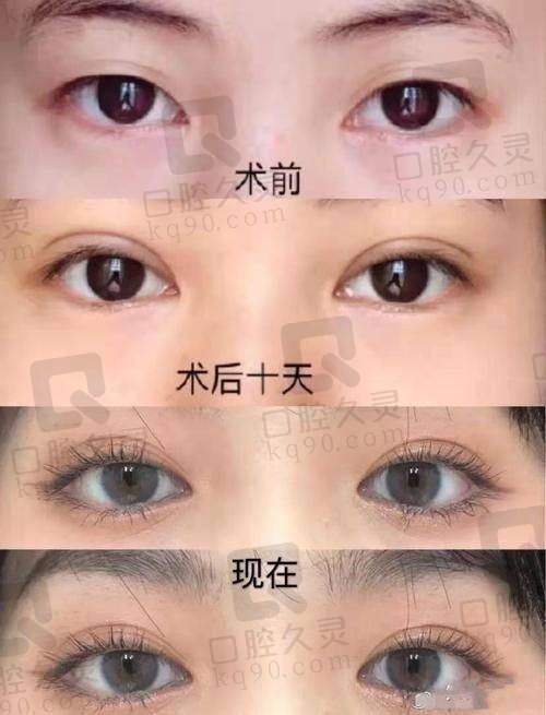 杭州艺星做双眼皮哪个医生好?杨连华和高士乾实力出众,技术风格各有千秋