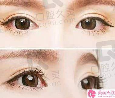 车红昌双眼皮修复案例:患者一月恢复妩媚大双眼,精湛技术成就自然美眼!