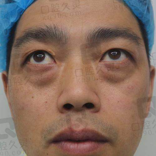 杭州黄良飞医生祛眼袋临床经验
