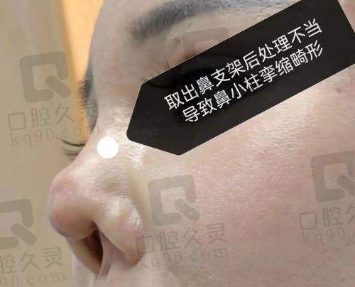 上海艺星鼻综合整形体验分享，术后鼻子形态自然立体，整个变美过程超安心 
