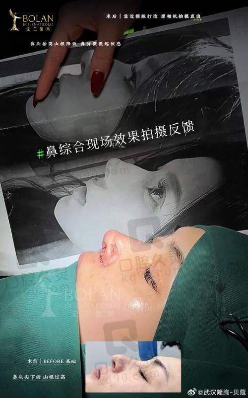 上海艺星鼻综合整形的成效怎么样？
