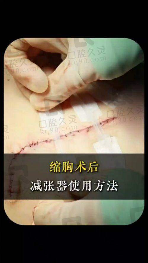 栗勇医生缩胸手术技术优势