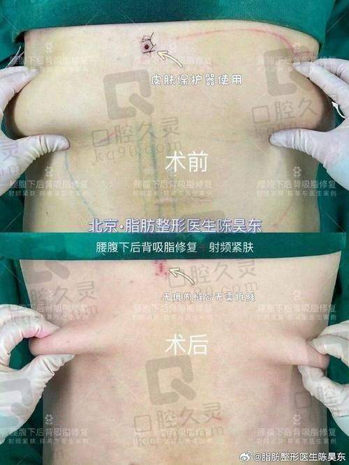 重庆军科整形吸脂医生哪个好？罗海军、王科、赵亚均技术优，口碑佳还能塑马甲线 