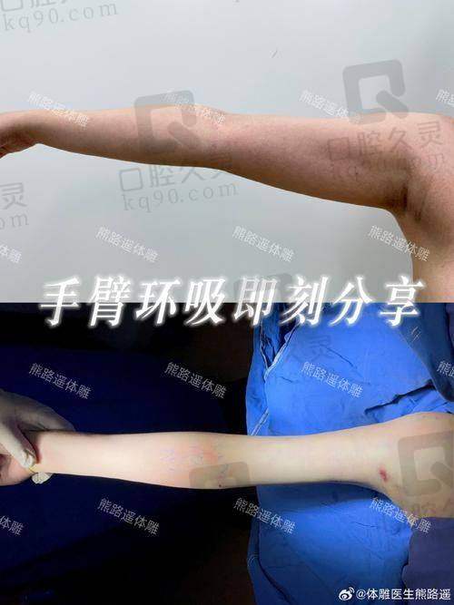 二、罗海军 医生吸脂技术优势
