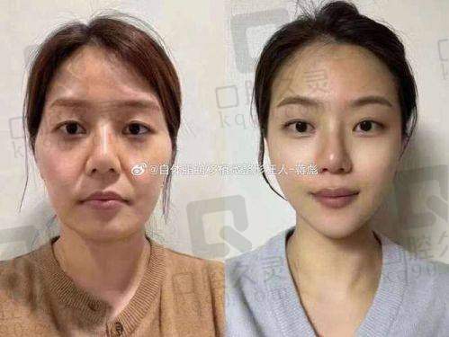 三、自体脂肪填充法令纹的成效与风险