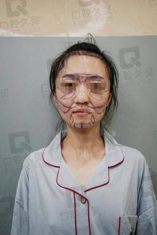 五、选择自体脂肪填充法令纹的注意事项