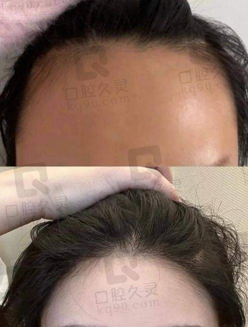 福州大麦微针植发门诊口碑如何？