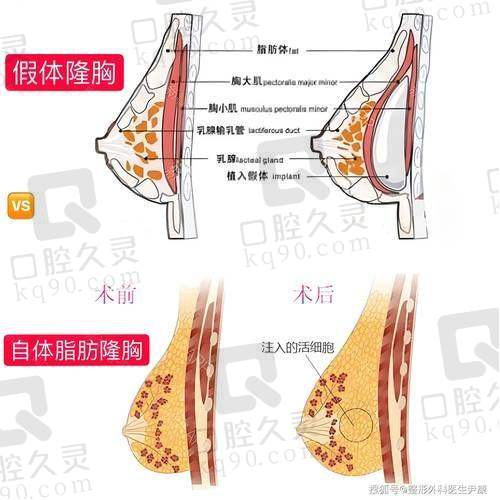 杭州时光黄良飞医生隆胸怎么样，下皱壁切口+内窥镜双平面技术，术后QQ弹2.6w元起