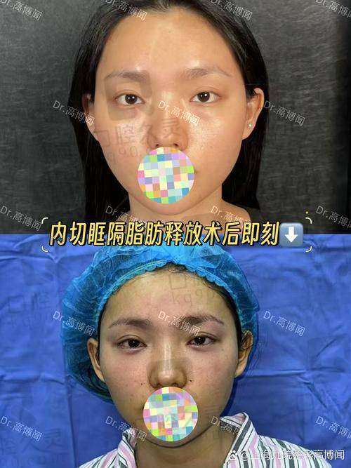 杭州黄良飞医生祛眼袋患者评价