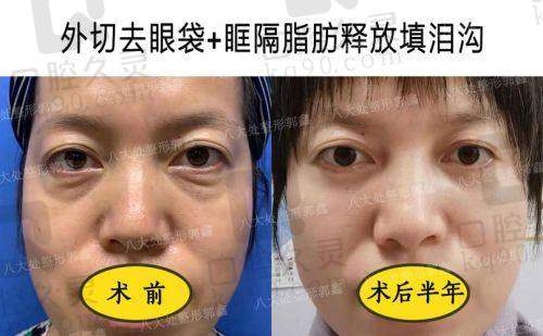 杭州黄良飞医生祛眼袋怎么样？技术优势、临床经验及患者评价全揭秘
