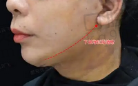 北京穆宝安跟李晓东那个做拉皮厉害？解析二人优势，揭秘拉皮界佼佼者 