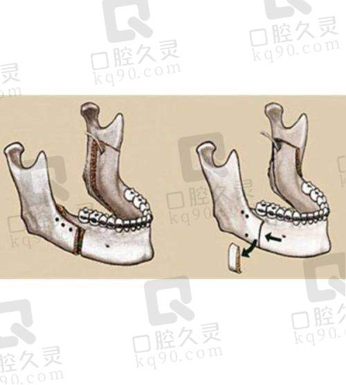 北京惠合嘉美医疗美容门诊部靠谱吗？吸脂、双眼皮项目及医生技术、口碑全解析