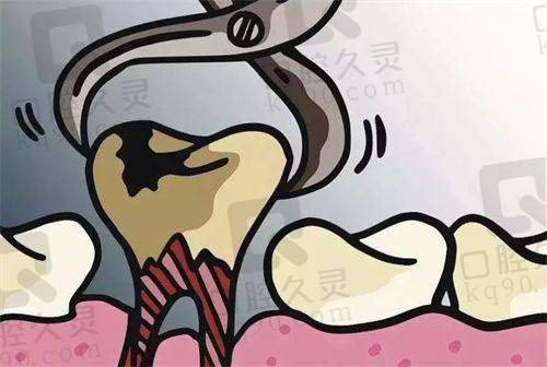 拔了四颗牙脸瘪了图：拔智齿的真实成效